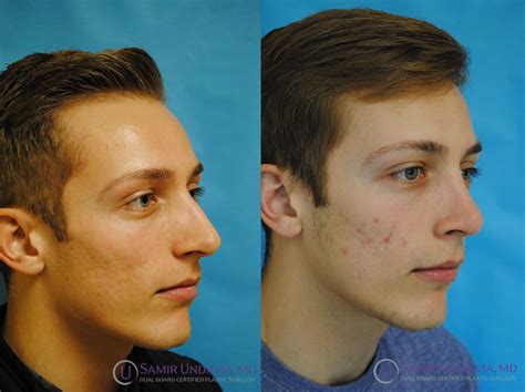 This Is A 6 Month Before And After Rhinoplasty Result Shows A Natural
