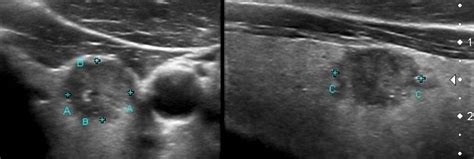 Papillary Thyroid Cancer Echocardiography Or Ultrasound Wikidoc