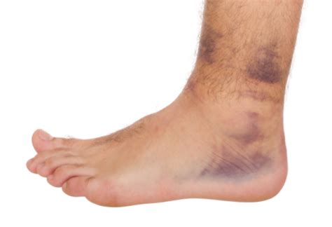 Sprain Vs Strain Whats The Difference Scenic City Clinic Of