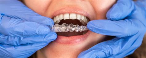 Does Invisalign Hurt Pinnacle Dental