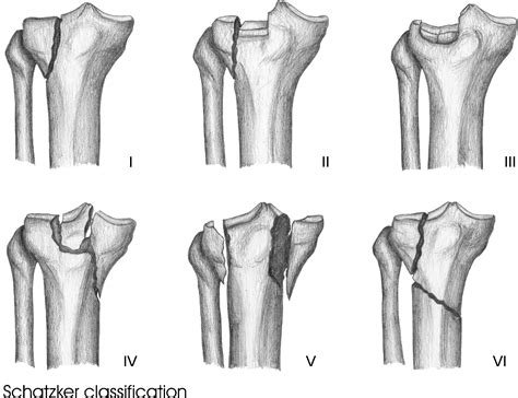 Classification Systems For Tibial Plateau Fractures Does Computed