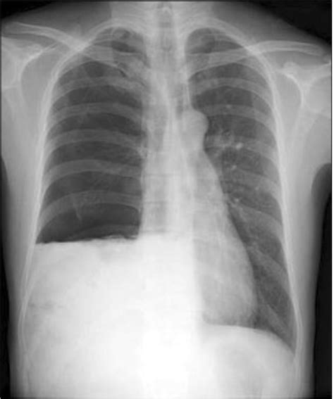 Chest X Ray Shows Right Sided Pneumothorax And Pleural Open I My XXX