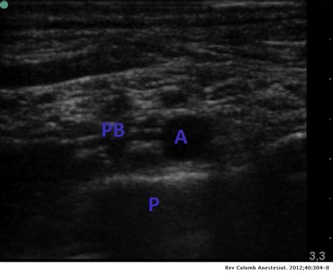 Bilateral Ultrasound Guided Supraclavicular Block Colombian Journal