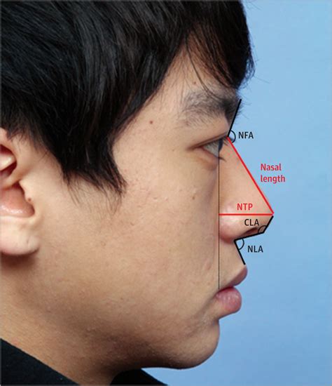Rhinoplasty For Short Noses In Asians Transplantation Jama Facial
