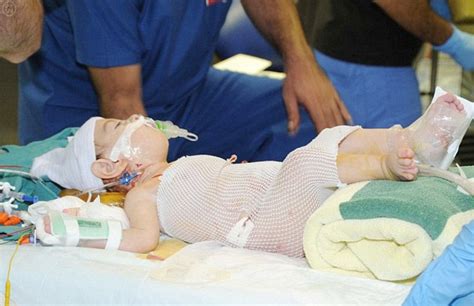 Conjoined Twins Doing Great After Surviving 9 Hour Separation Surgery