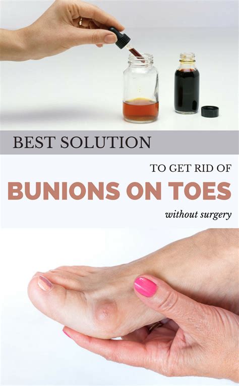 Bunion splint or pad that you can wear and a shoe that it fits into and still go about your normal life. Best Solution to Get Rid of Bunions on Toes Without ...