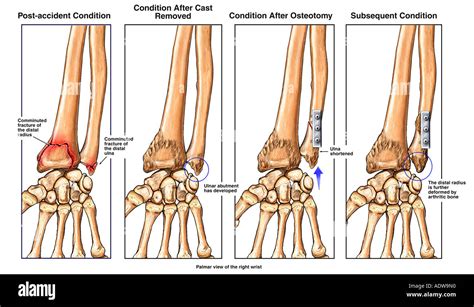 Broken Wrist Fractured Radius And Ulna With Ulnar Shortening Stock