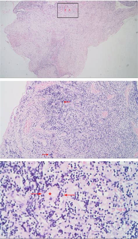 Histopathology Top This Picture Demonstrated Granuloma With Caseous