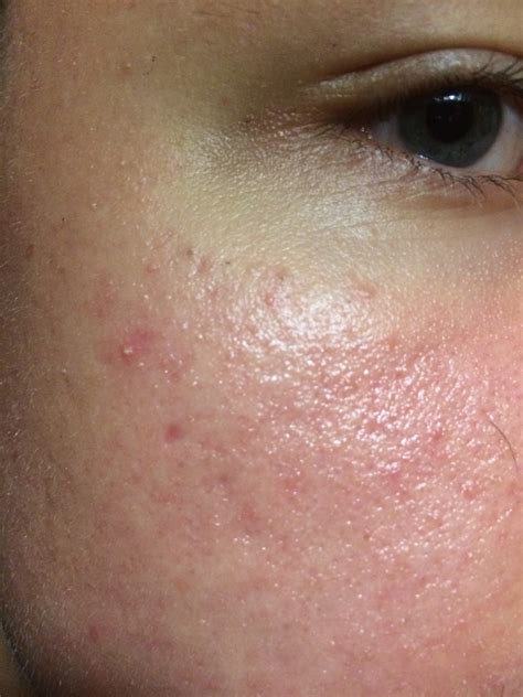 Small Rash On Face