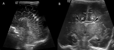 A Rare Case Of A Neonate With Agenesis Of The Corpus Callosum And