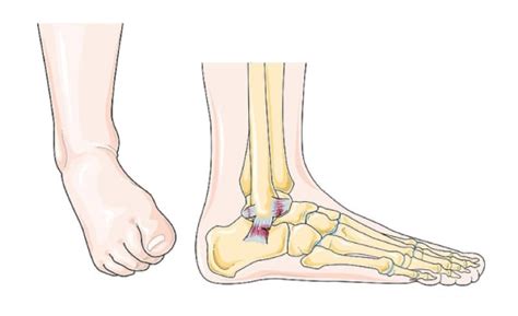 Why Is Ankle Dorsiflexion So Critical — Pinnacle Physical Therapy