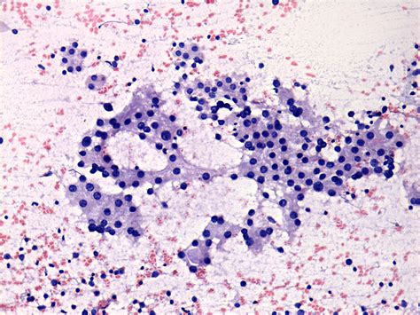 Chronic Lymphocytic Thyroiditis