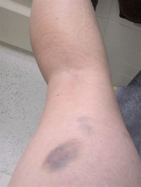 Pictures Of Bruises On Legs Wildcard Reining