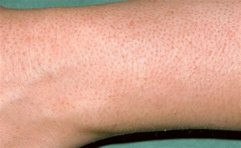 Keratosis Pilaris Or Bumpy Skin On Arms Treatment Skincarederm