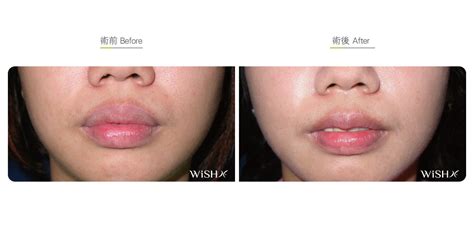 lip reduction sexy lip surgery lip plasty wishclinic