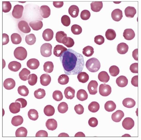 T Cell Large Granular Lymphocytic Leukemia Basicmedical Key