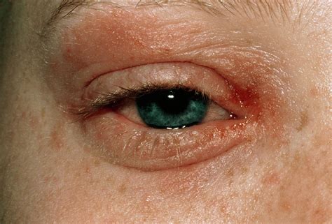 Eczema Around Eye Of A Patient Photograph By Dr P Marazziscience