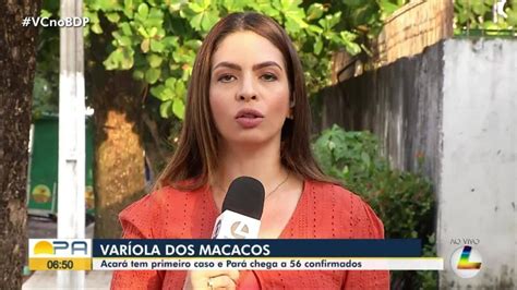 Var Ola Dos Macacos Acar Tem Primeiro Caso Da Doen A E Par Chega A