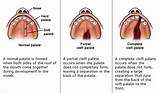 Cleft Palate Roof Of Mouth Images