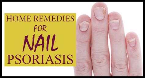 Home Remedies For Nail Psoriasis Remedies Lore