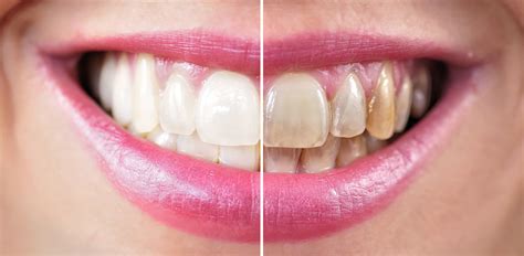 Teeth Whitening Specials 209 Nyc Dental