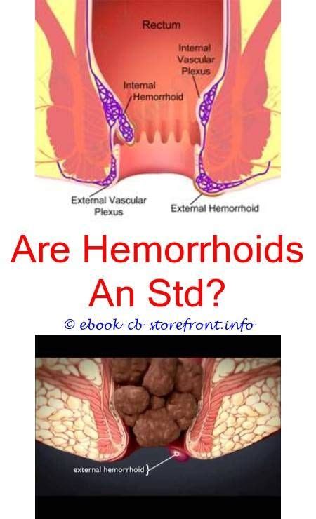 Pin On How Long After Hemorrhoid Surgery Can I Exercise