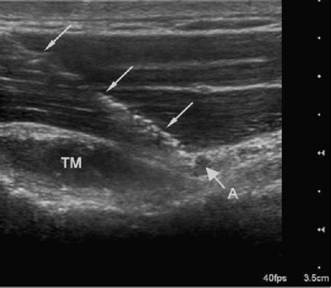 Figure 4 From Ultrasound Guided Block Of The Axillary Nerve A