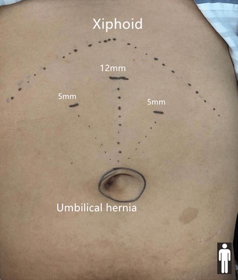 Schematic Diagram Of Port Placement For Primary Umbilical Hernia Repair