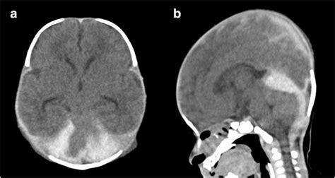 Axial Left And Sagittal Right Images From Computed Tomography Ct