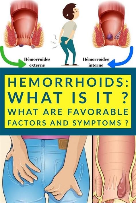Hemorrhoids What Is It What Are Favorable Factors And Symptoms
