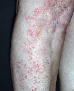 Ivermectin therefore warrants further investigation for possible benefits in humans, explains the so the probability of ivermectin being used safely to kill the virus in people must be considered low, he. Krätze: Nachts ist der Juckreiz am stärksten | PTA-Forum