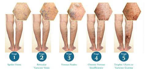 Chronic Venous Insufficiency Stages Of Venous Disease Venous Stasis