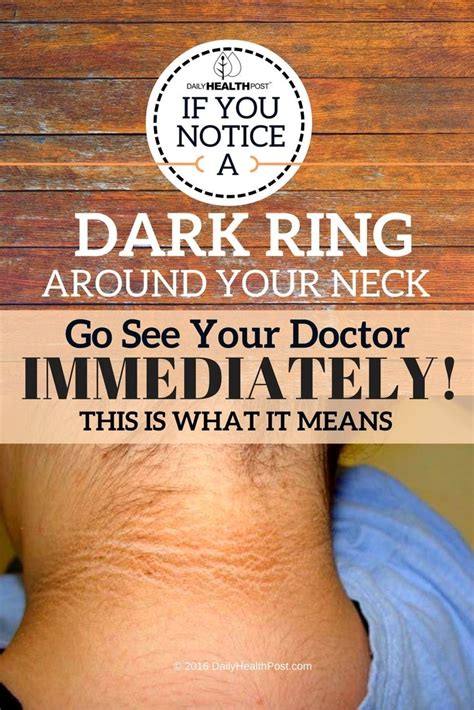 If You Notice A Dark Ring Around Your Neck Go See Your Doctor