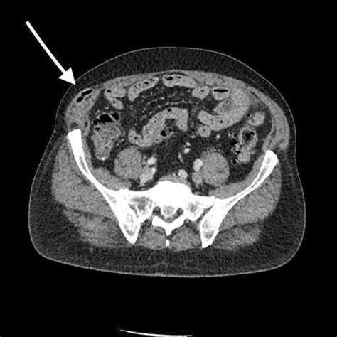 Ct Scan Showing Spigelian Hernia Containing The Appendix Arrow