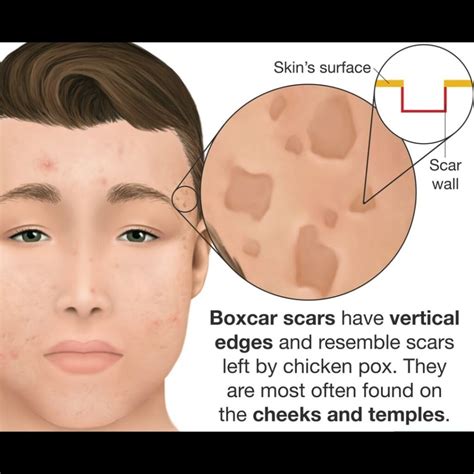 Boxcar Acne Scars A Overview My Acne Scars