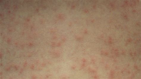 Causes Of Red Bumps On Legs