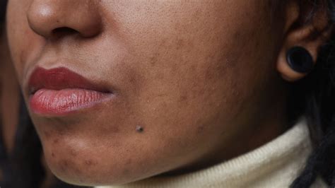 How To Treat Acne And Post Acne Marks On Dark Skin According To A Dermatologist — See Video