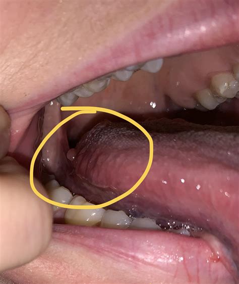 Painful Bump On Side Of Tonguejust Noticed It Today Rdiagnoseme