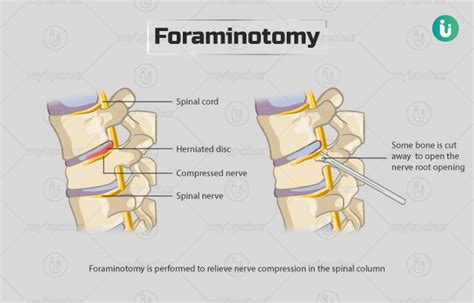 Foraminotomy Procedure Purpose Results Cost Price Indications Recovery