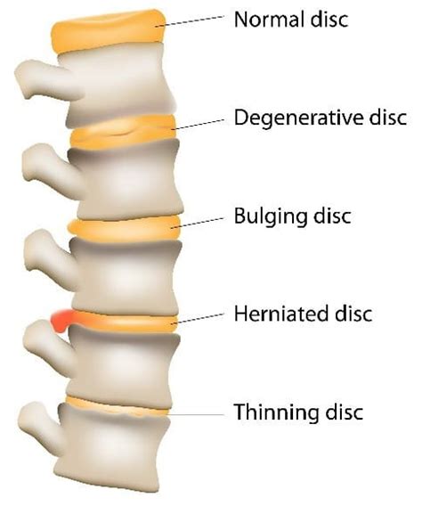 Bulging Disc Relief Gentle And Safe Chiropractor Hq