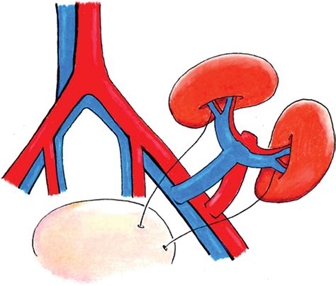 Pediatric En Bloc Kidney Transplants Clinical And Immediate