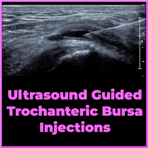 Trochanteric Bursa Injection Ultrasound Sports Medicine Review
