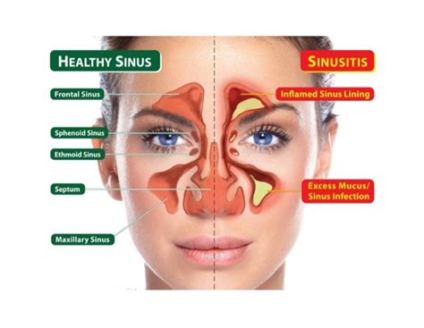 Chronic Sinusitis Symptoms Causes Treatment