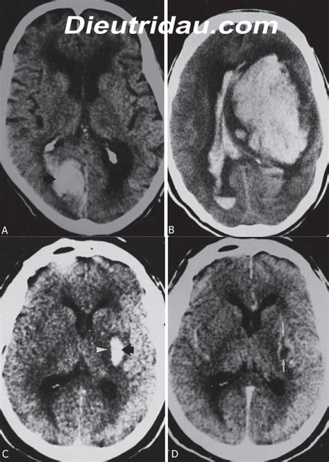 Hemorrhagic Stroke Imaging Pain Management