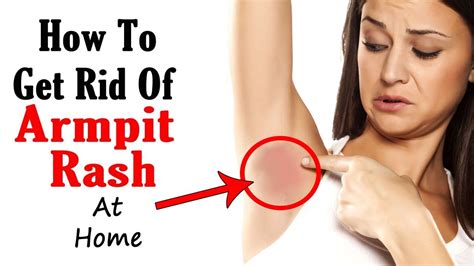How To Treat Armpit Rash Naturally Home Remedies For Underarm Rash Treatment Youtube