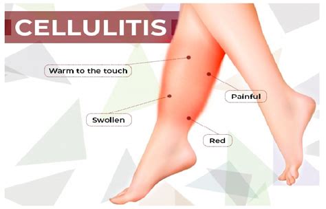 Cellulitis Definition Causes Treatment And More