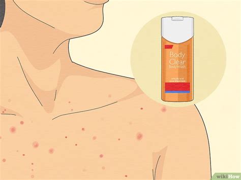 How To Get Rid Of Chest Acne Fast According To Experts