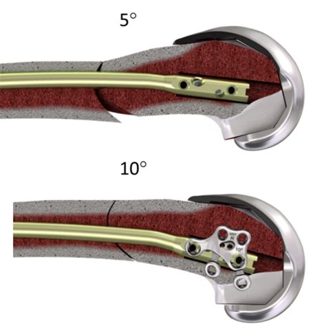 Rfn Advanced™ Retrograde Femoral Nailing System Depuy Synthes