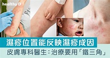 濕疹根治 | 皮膚專科醫生：治療要用「鐵三角」認識濕疹成因、症狀、位置反映、種類、治療及飲食 | healthyD.com