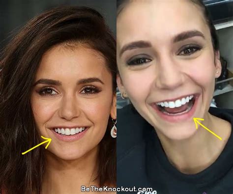 Nina Dobrev Nose Job Before And After